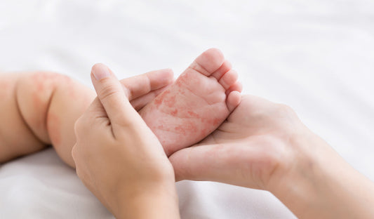 Rubella