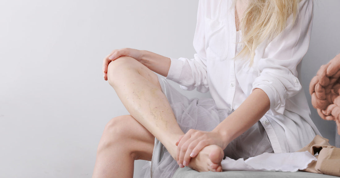 Woman with varicose veins and spider veins during pregnancy