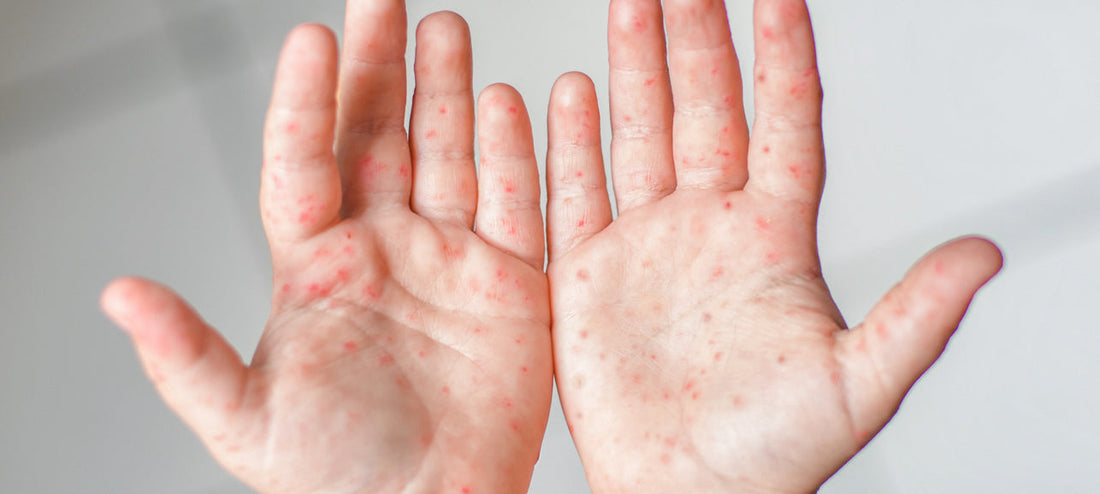 Toddler shows his palms with red spots due to hand-foot-and-mouth disease