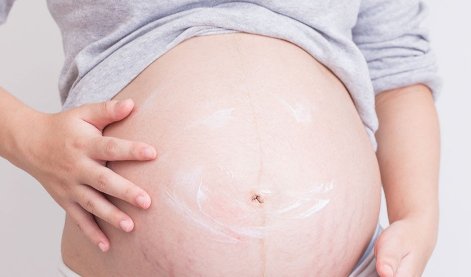 5 Tips to Prevent Stretch Marks During Pregnancy
