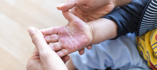 Mother holds the hand of a child with a burn