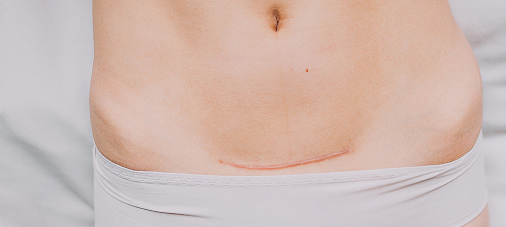 Scar care after cesarean section