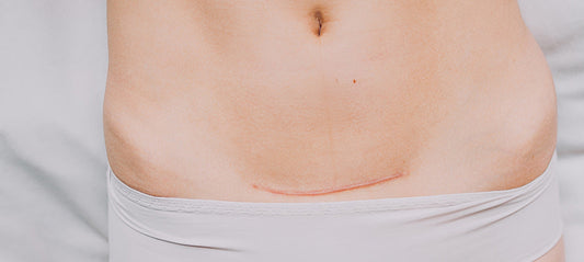 Scar care after cesarean section