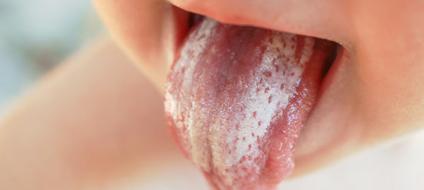 The most common childhood illnesses: Scarlet Fever